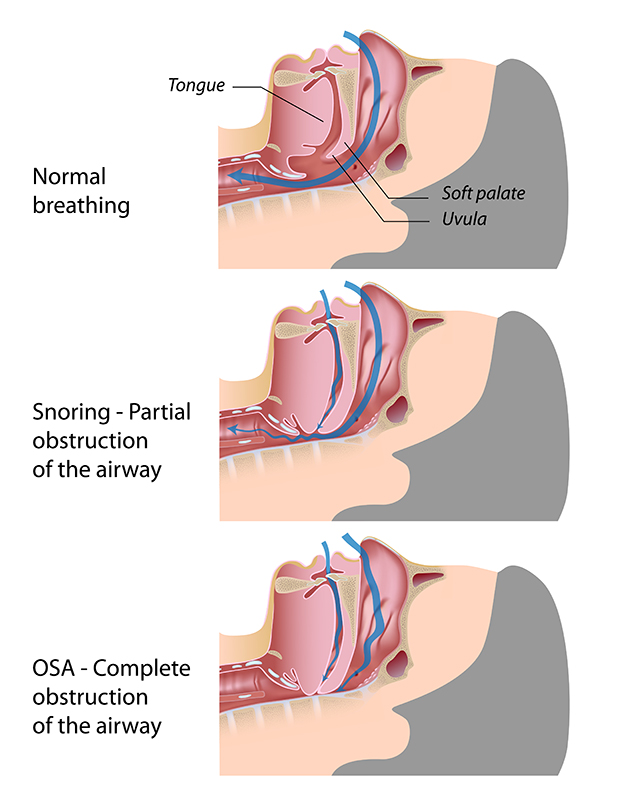obstructive-sleep-apnea-4